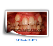Apinyament dental